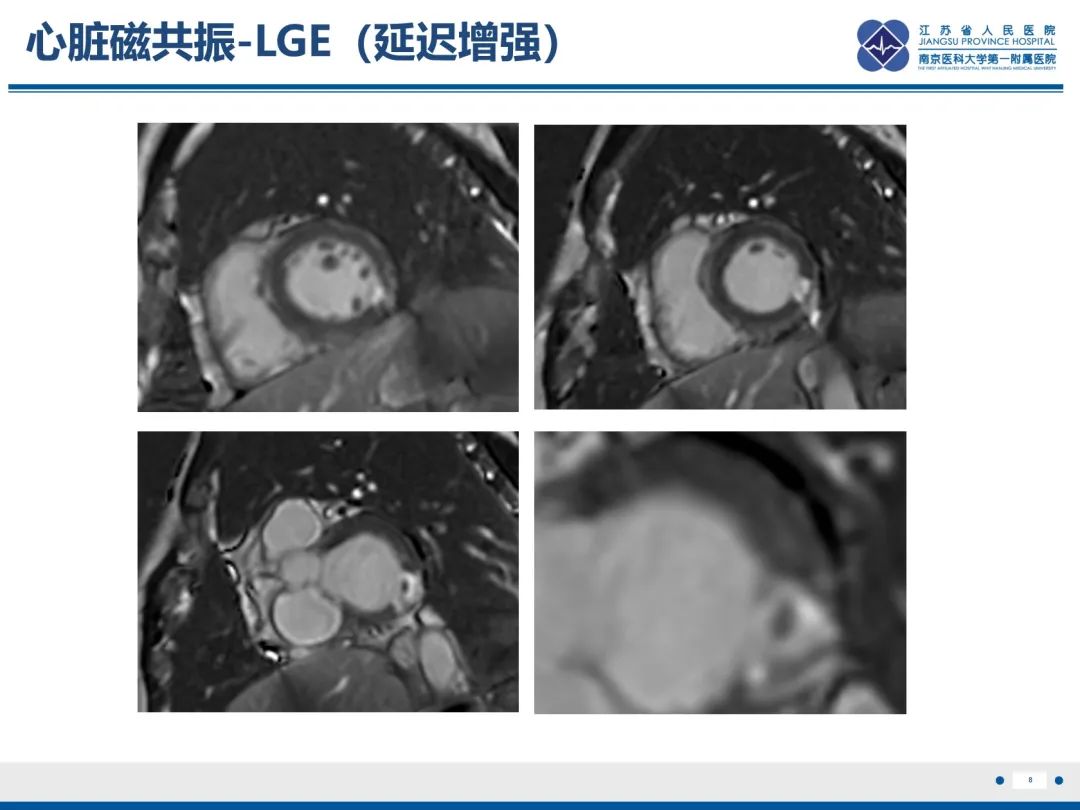 影像PPT - 【PPT】冠脉非阻塞型心肌梗死-9
