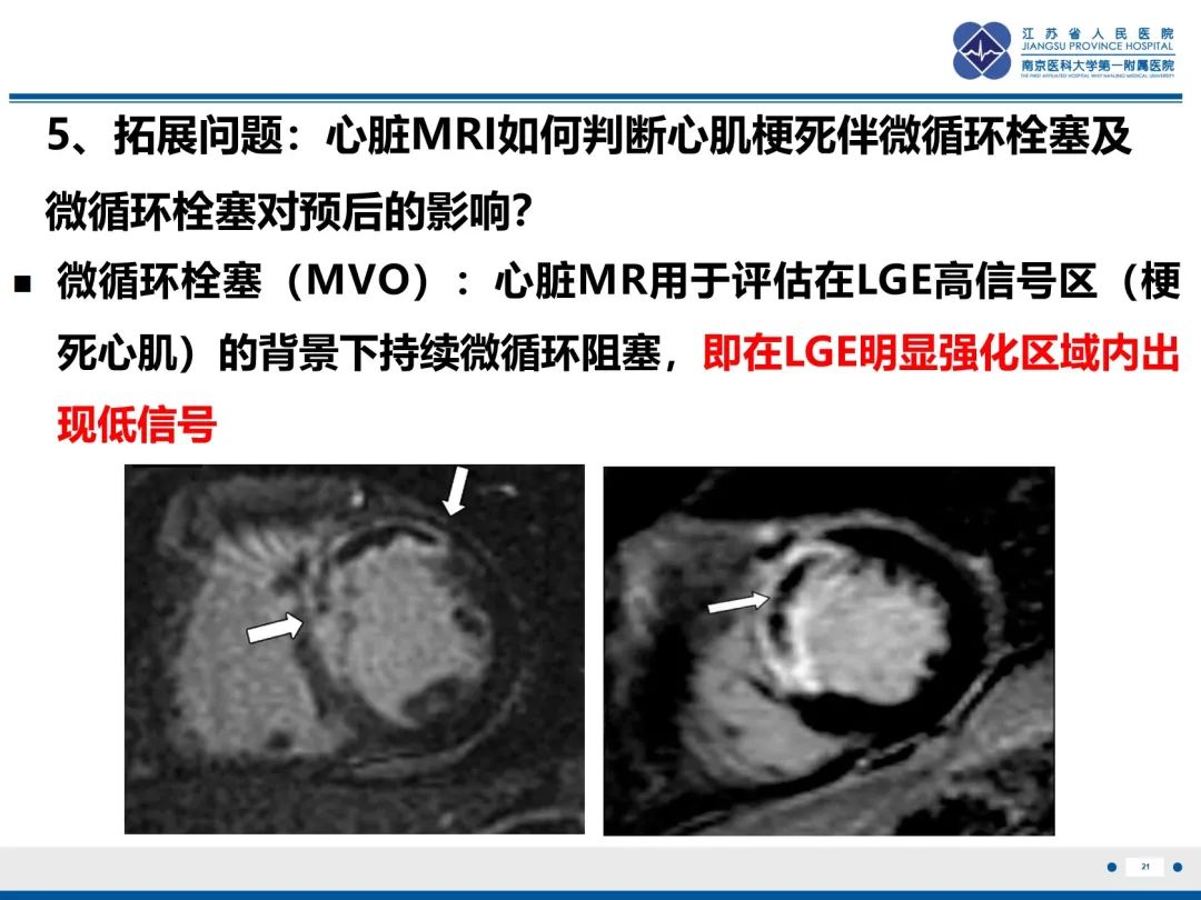 影像PPT - 【PPT】冠脉非阻塞型心肌梗死-22
