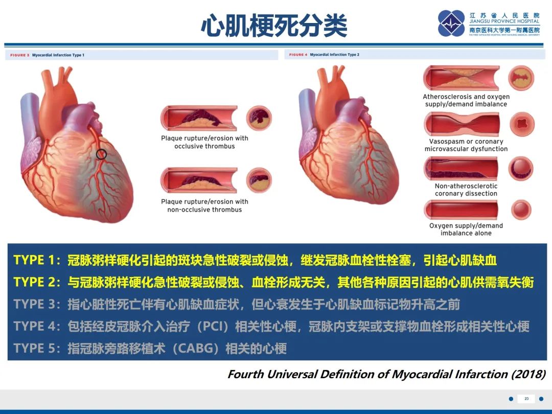 影像PPT - 【PPT】冠脉非阻塞型心肌梗死-24