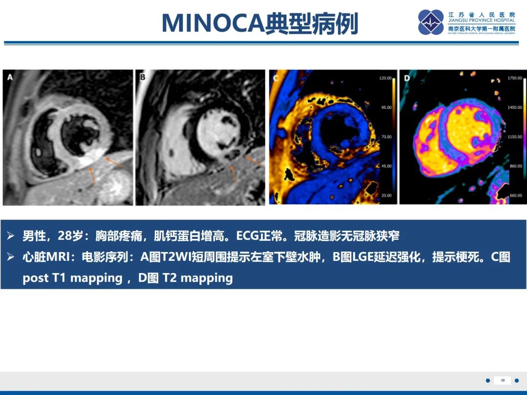影像PPT - 【PPT】冠脉非阻塞型心肌梗死-31