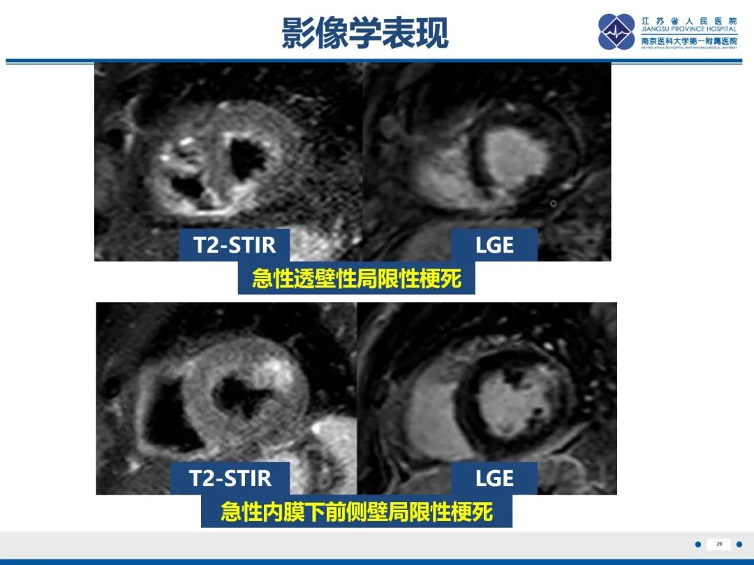 影像PPT - 【PPT】冠脉非阻塞型心肌梗死-30