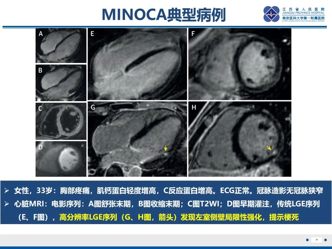 影像PPT - 【PPT】冠脉非阻塞型心肌梗死-32