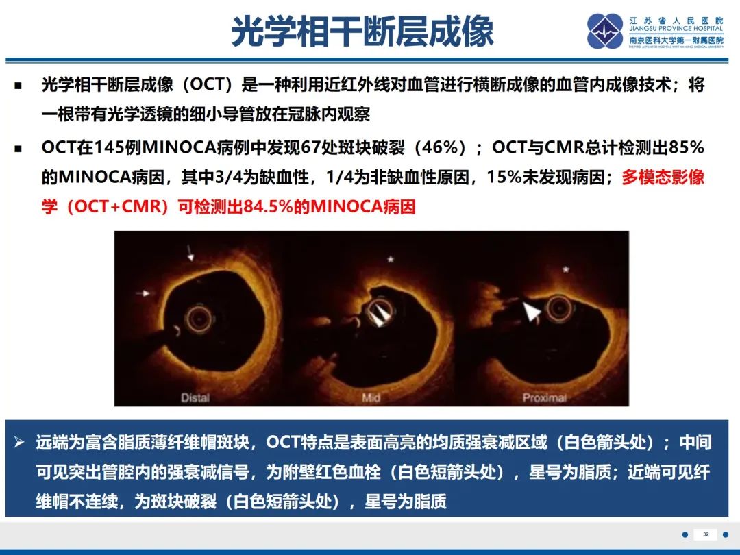 影像PPT - 【PPT】冠脉非阻塞型心肌梗死-33