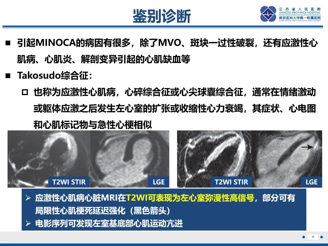影像PPT - 【PPT】冠脉非阻塞型心肌梗死-39