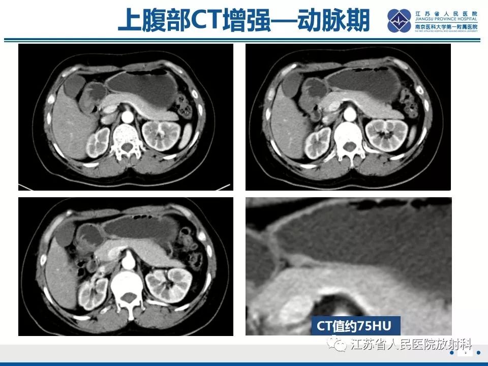 影像PPT - 【PPT】异位胰腺-4