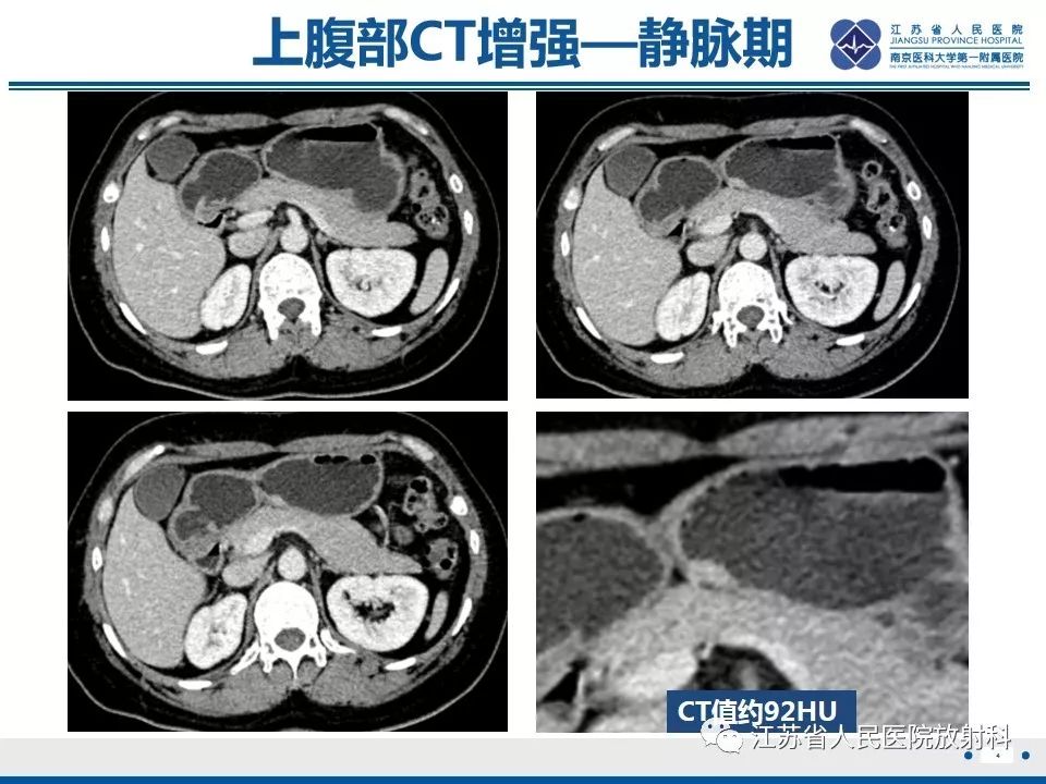 影像PPT - 【PPT】异位胰腺-5