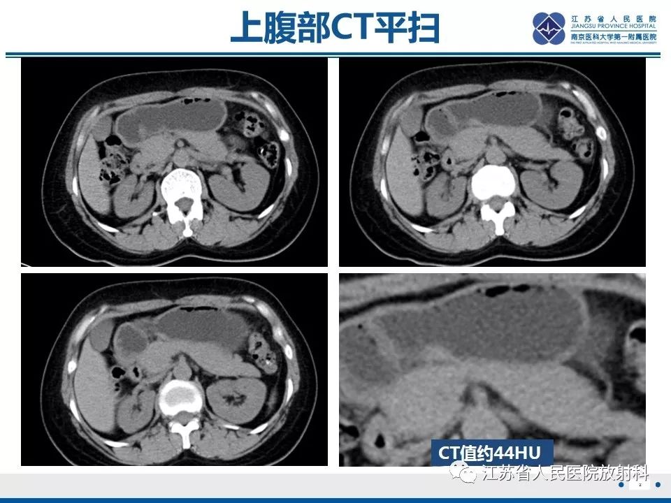 影像PPT - 【PPT】异位胰腺-3