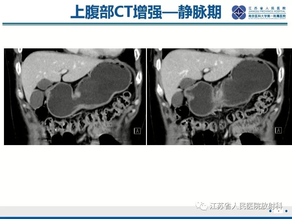 影像PPT - 【PPT】异位胰腺-6