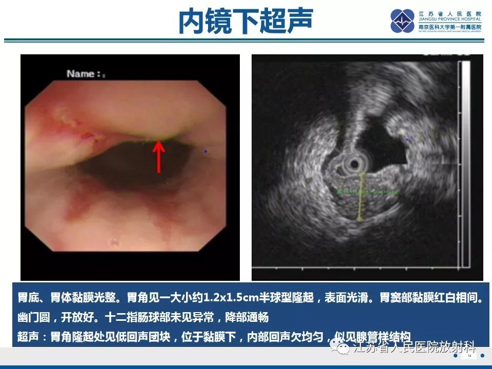 影像PPT - 【PPT】异位胰腺-13