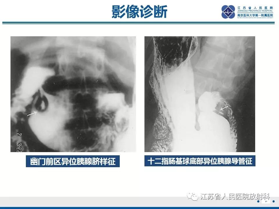 影像PPT - 【PPT】异位胰腺-22