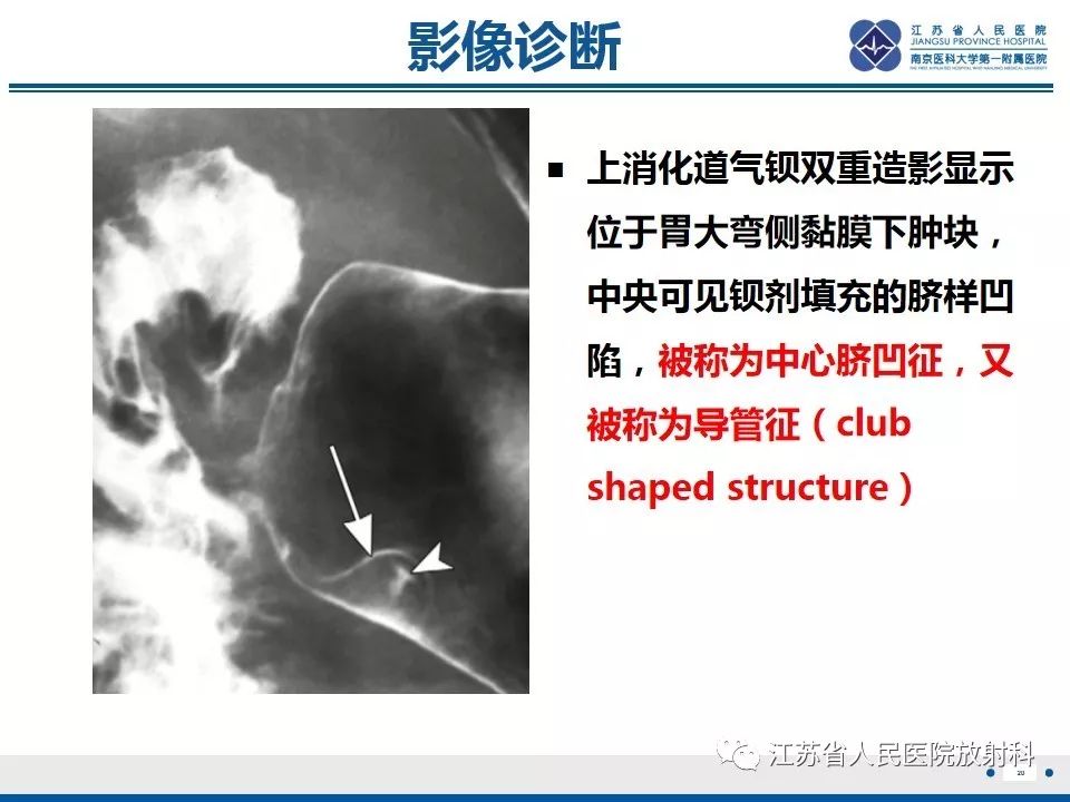 影像PPT - 【PPT】异位胰腺-21