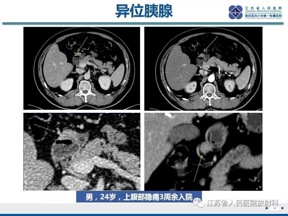 影像PPT - 【PPT】异位胰腺-24