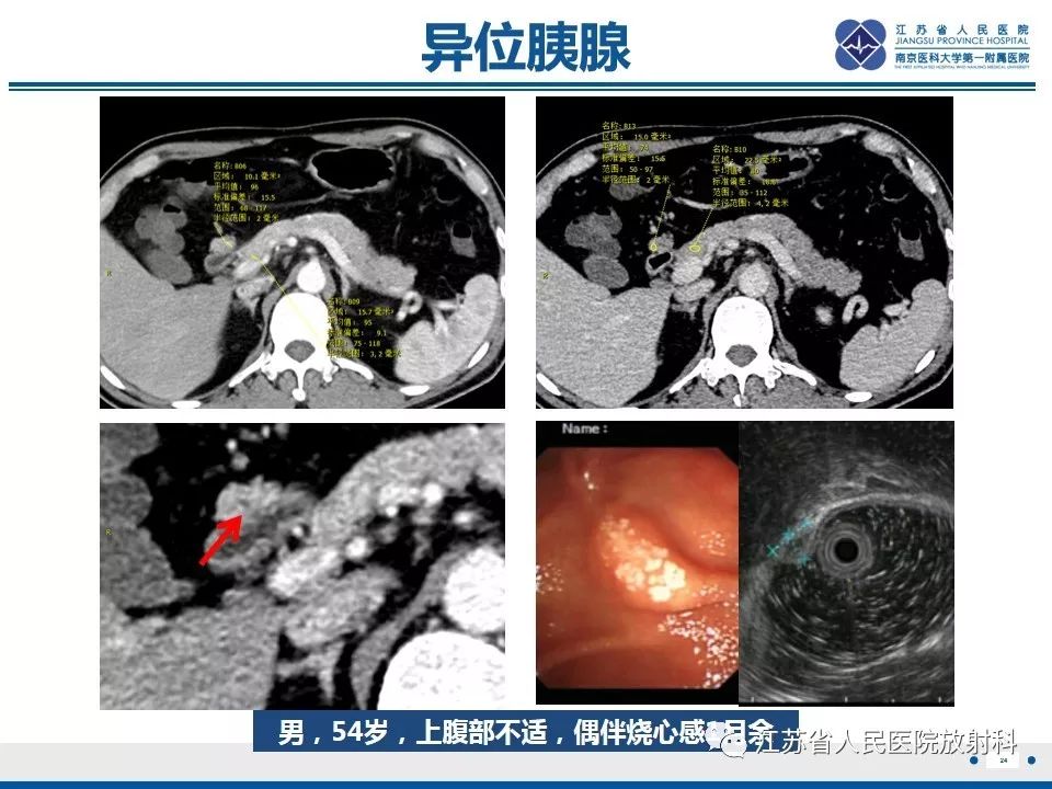影像PPT - 【PPT】异位胰腺-25