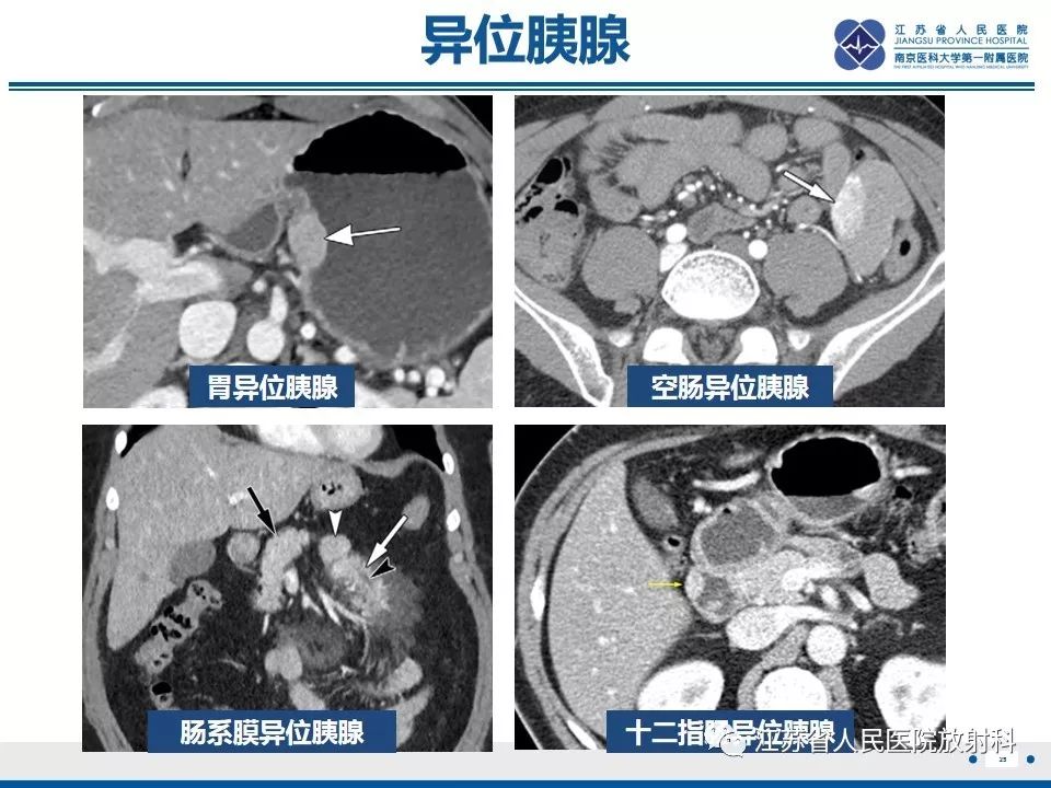 影像PPT - 【PPT】异位胰腺-26
