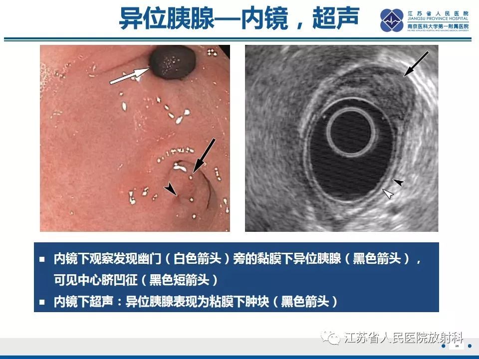 影像PPT - 【PPT】异位胰腺-27