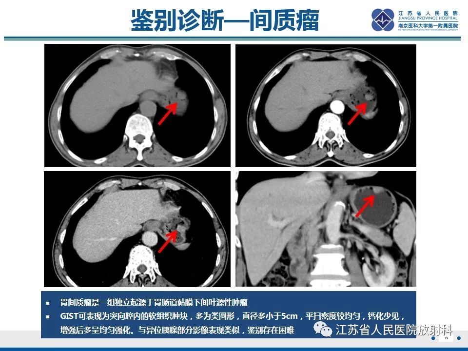 影像PPT - 【PPT】异位胰腺-30