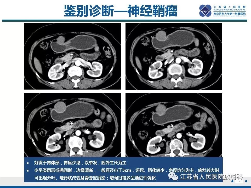 影像PPT - 【PPT】异位胰腺-32