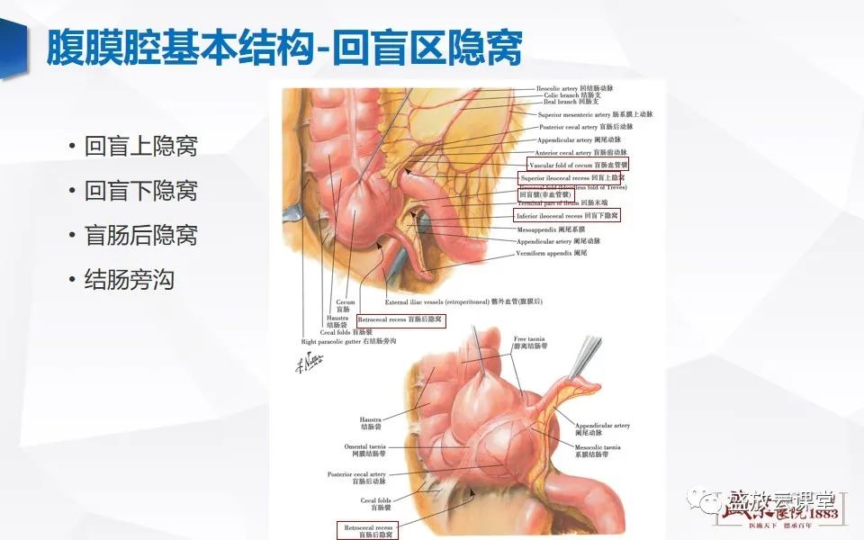 影像PPT - 【PPT】先天性腹内疝的影像诊断思路-14