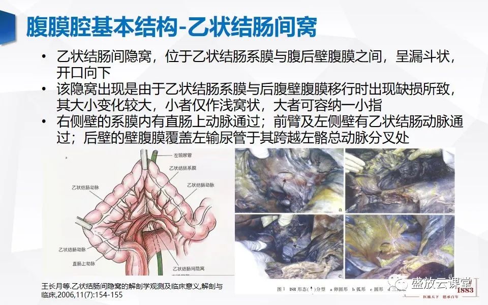 影像PPT - 【PPT】先天性腹内疝的影像诊断思路-15