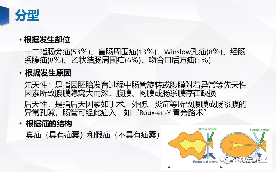 影像PPT - 【PPT】先天性腹内疝的影像诊断思路-17