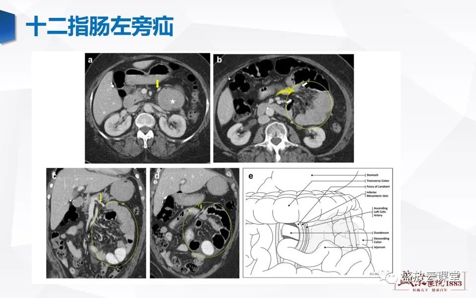 影像PPT - 【PPT】先天性腹内疝的影像诊断思路-22
