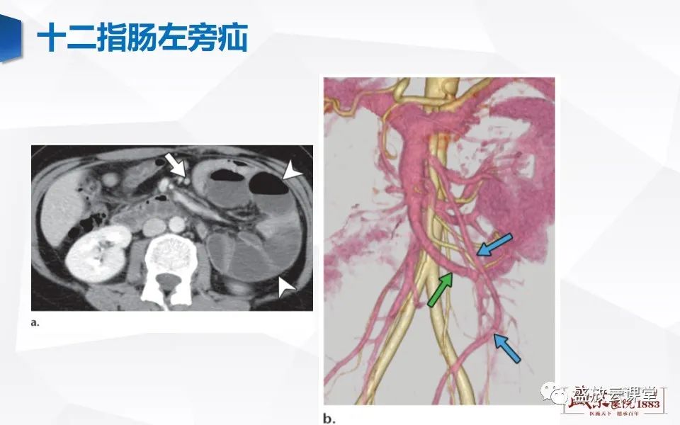 影像PPT - 【PPT】先天性腹内疝的影像诊断思路-23