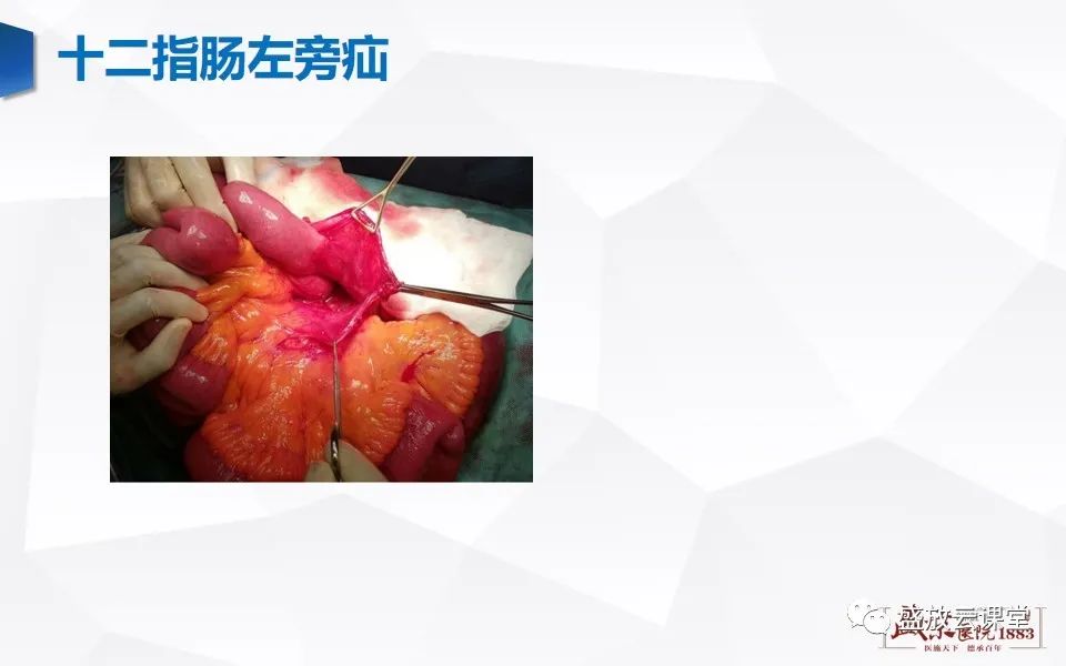 影像PPT - 【PPT】先天性腹内疝的影像诊断思路-24