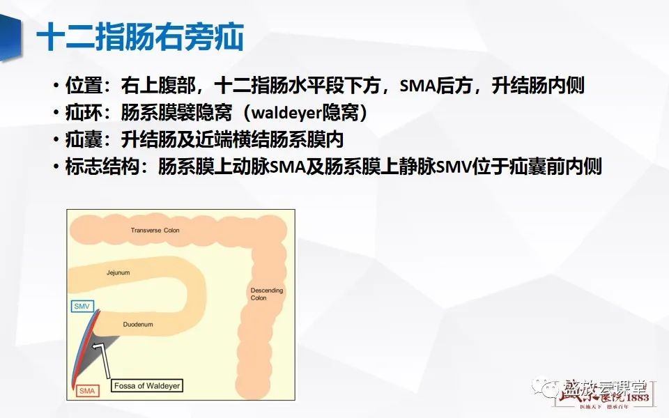 影像PPT - 【PPT】先天性腹内疝的影像诊断思路-25