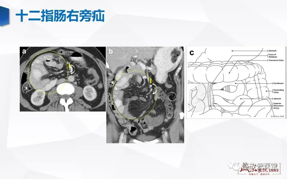 影像PPT - 【PPT】先天性腹内疝的影像诊断思路-26