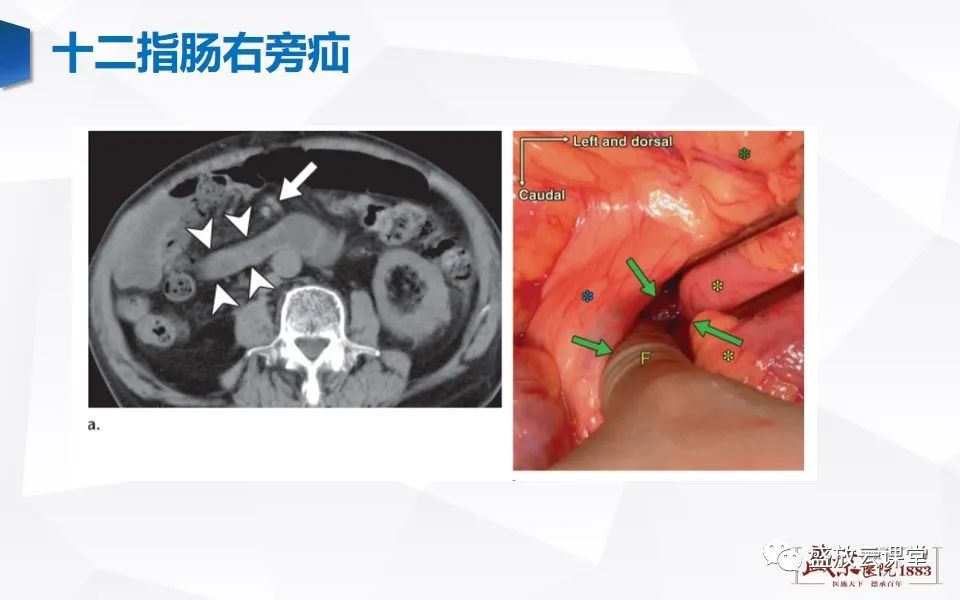 影像PPT - 【PPT】先天性腹内疝的影像诊断思路-27