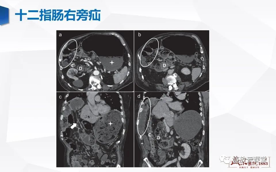 影像PPT - 【PPT】先天性腹内疝的影像诊断思路-28