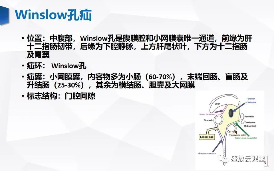 影像PPT - 【PPT】先天性腹内疝的影像诊断思路-29