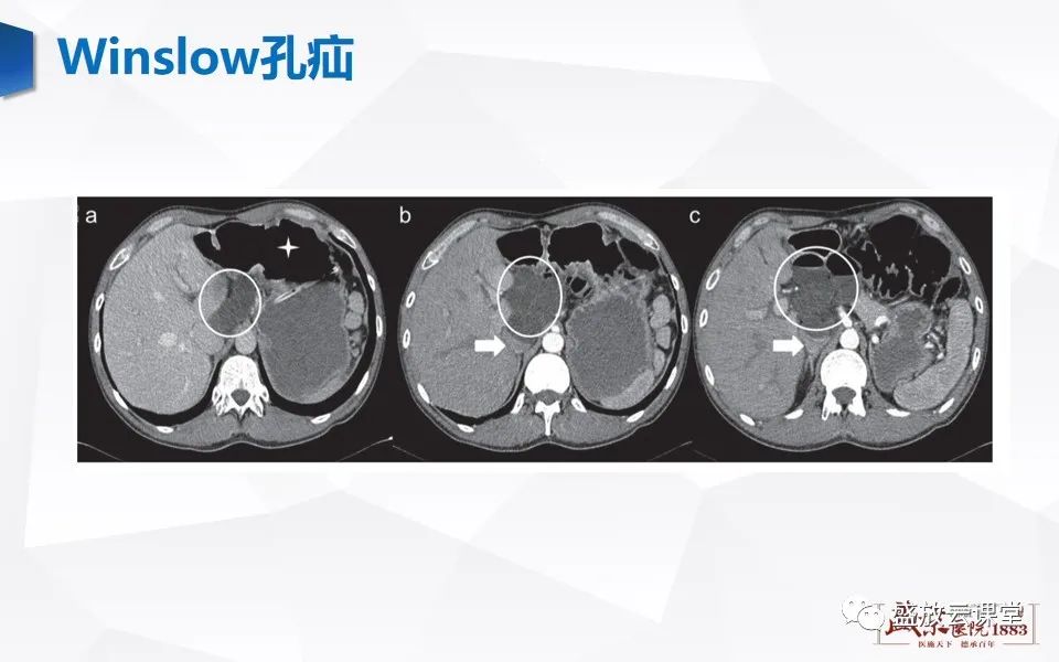 影像PPT - 【PPT】先天性腹内疝的影像诊断思路-30