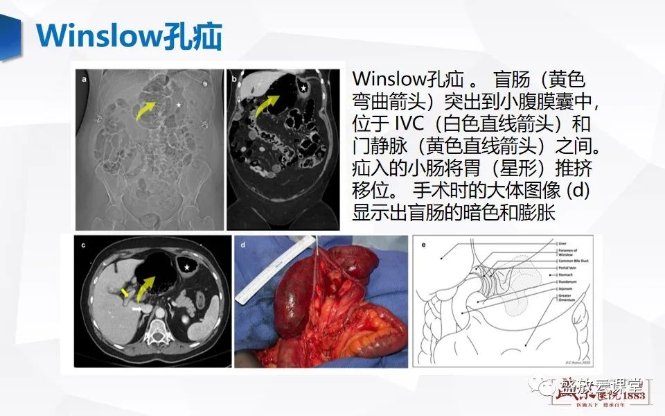 影像PPT - 【PPT】先天性腹内疝的影像诊断思路-31