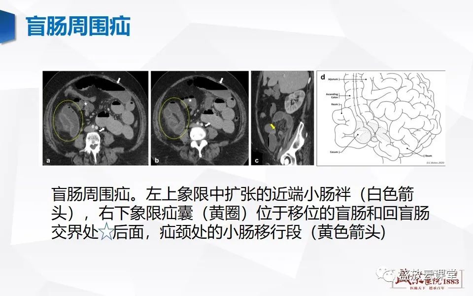 影像PPT - 【PPT】先天性腹内疝的影像诊断思路-33