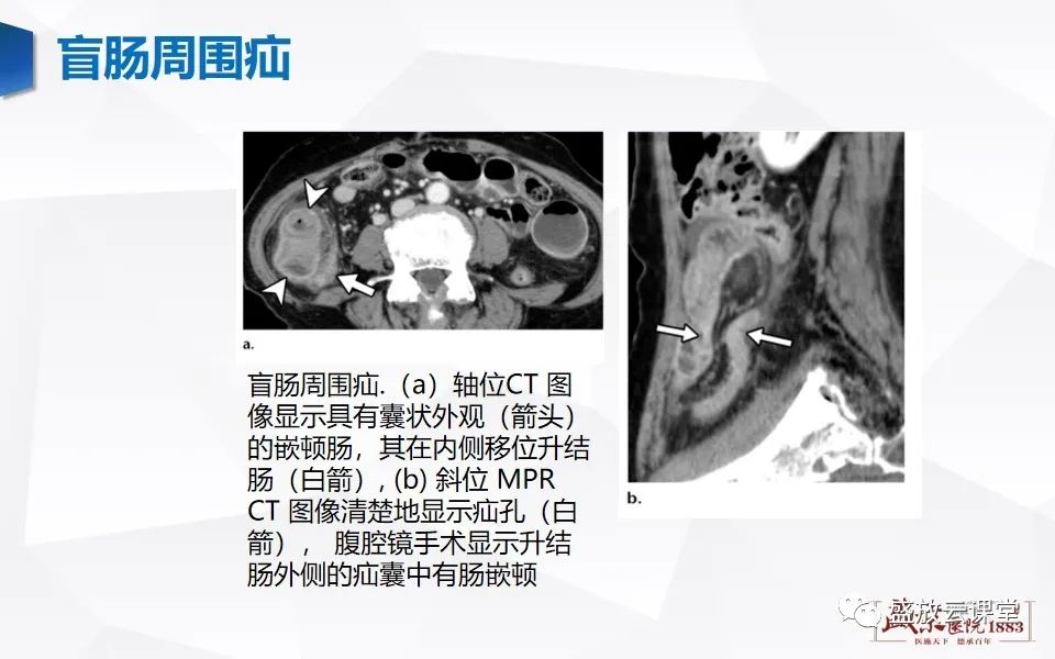 影像PPT - 【PPT】先天性腹内疝的影像诊断思路-34