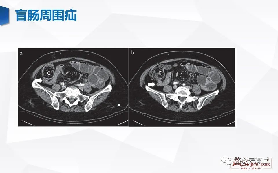 影像PPT - 【PPT】先天性腹内疝的影像诊断思路-35