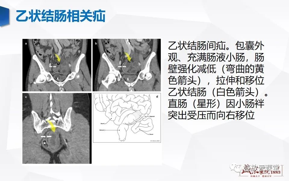影像PPT - 【PPT】先天性腹内疝的影像诊断思路-37