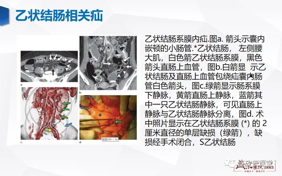 影像PPT - 【PPT】先天性腹内疝的影像诊断思路-38