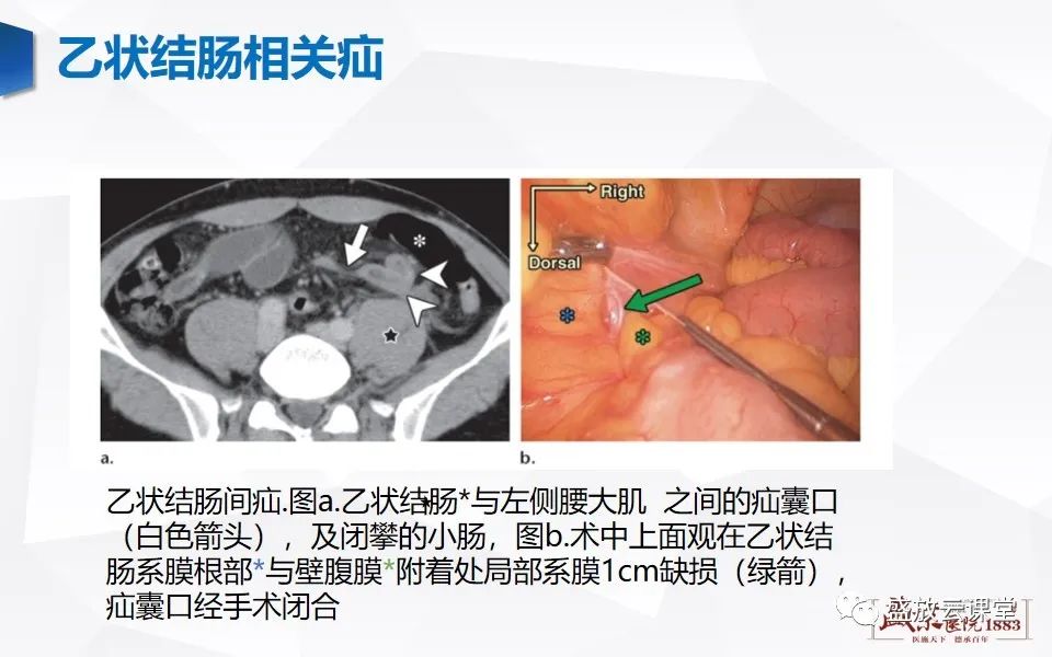 影像PPT - 【PPT】先天性腹内疝的影像诊断思路-39