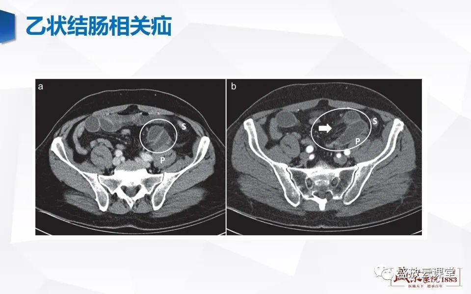 影像PPT - 【PPT】先天性腹内疝的影像诊断思路-40