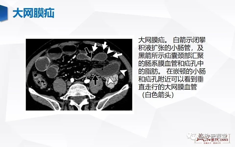 影像PPT - 【PPT】先天性腹内疝的影像诊断思路-42