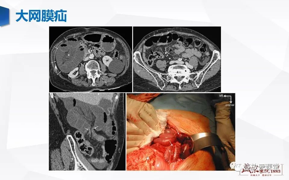 影像PPT - 【PPT】先天性腹内疝的影像诊断思路-43