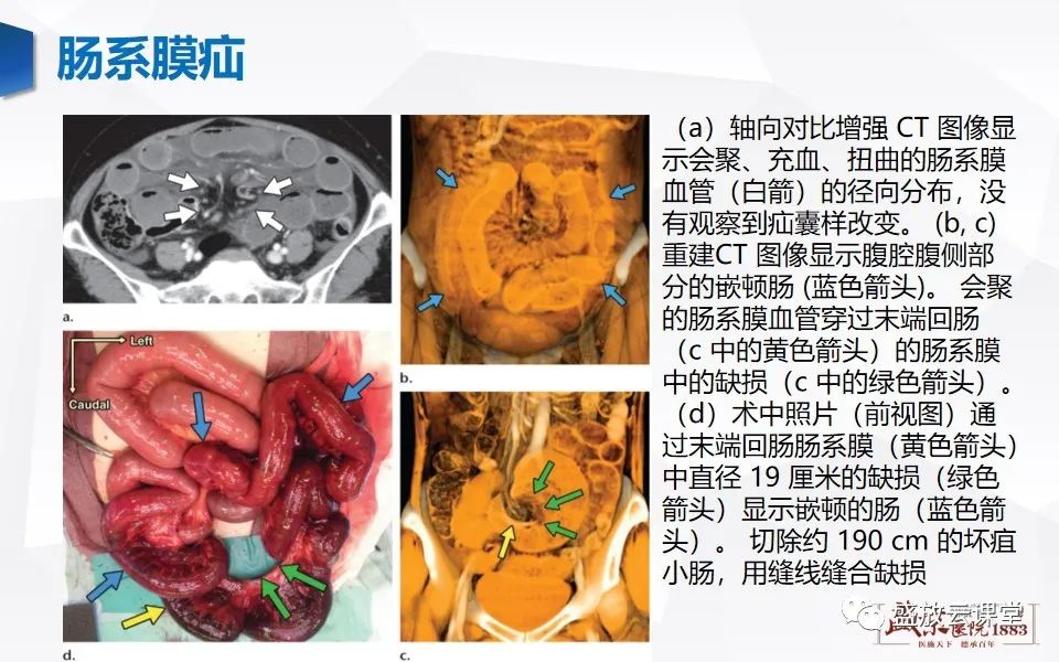 影像PPT - 【PPT】先天性腹内疝的影像诊断思路-46