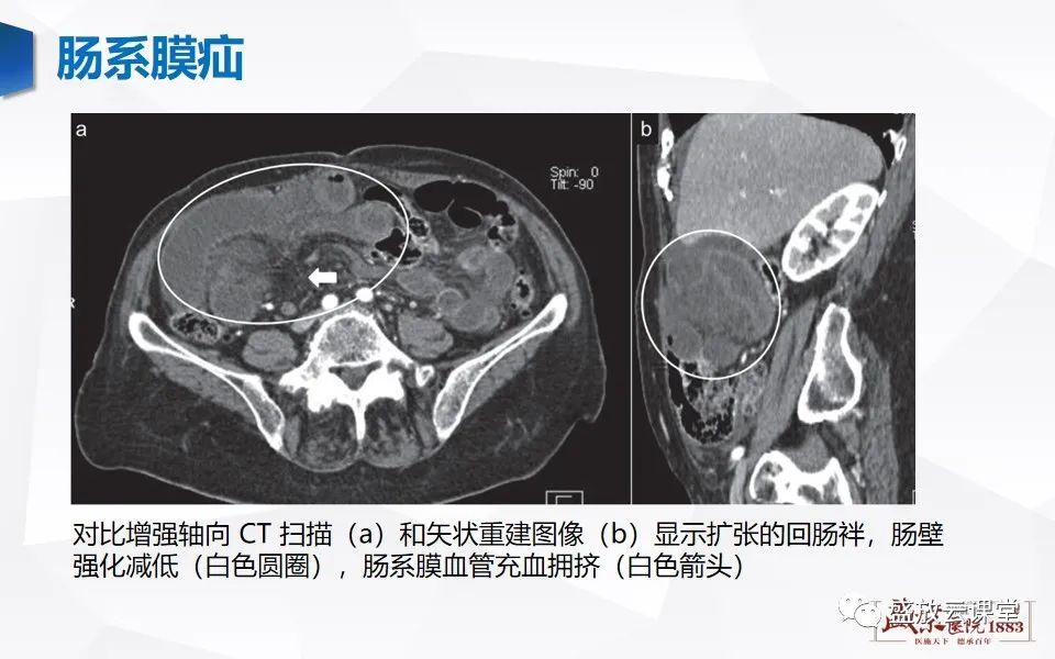 影像PPT - 【PPT】先天性腹内疝的影像诊断思路-47