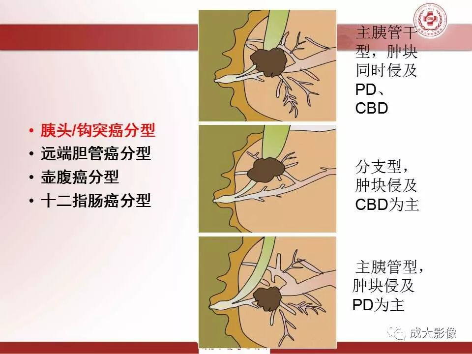 影像PPT - 【PPT】壶腹部周围癌的鉴别-10