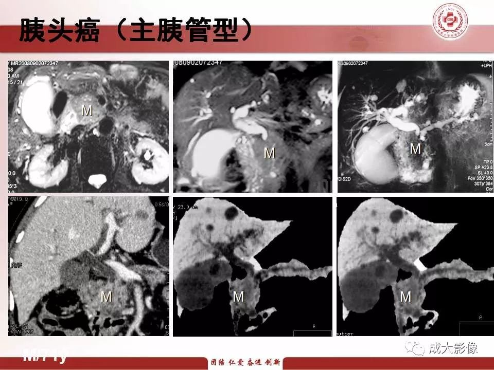 影像PPT - 【PPT】壶腹部周围癌的鉴别-11