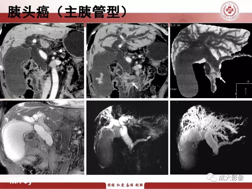 影像PPT - 【PPT】壶腹部周围癌的鉴别-12