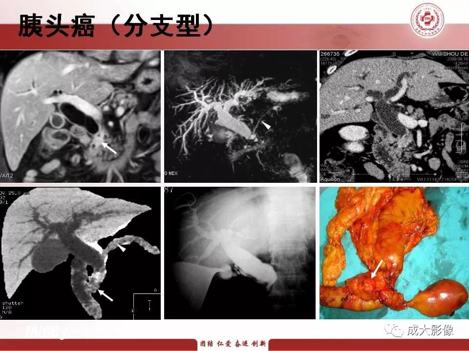 影像PPT - 【PPT】壶腹部周围癌的鉴别-13