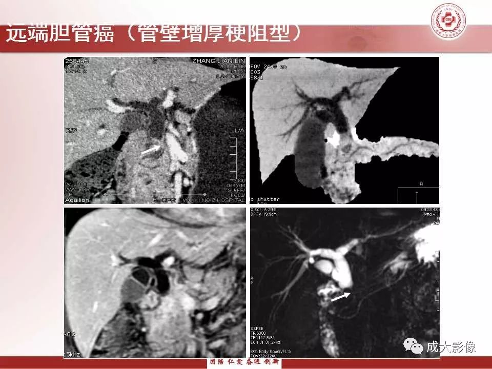 影像PPT - 【PPT】壶腹部周围癌的鉴别-16